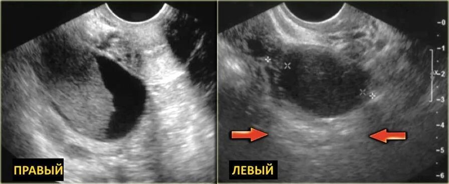 Какая норма кисты. Кистозно-Солидное образование яичника УЗИ. Геморрагическая киста желтого тела на УЗИ. Регрессирующая фолликулярная киста. Геморрагическая киста яичников на УЗИ.