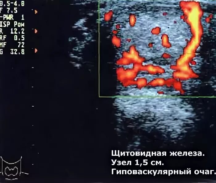 Узел в правой доле щитовидной железы. Диффузная гиперплазия щитовидной железы узлы правой доли. Диффузно-очаговые изменения щитовидной железы что это такое. Диффузные изменения в ткани щитовидной железы . Узлы в левой доле. УЗИ очаговых изменений щитовидной железы ЛК.