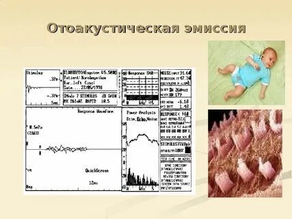 Отоакустическая эмиссия