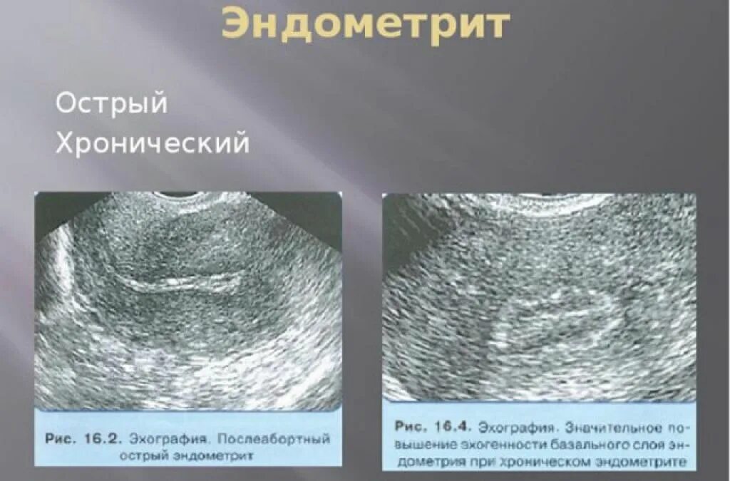 Эндометрия стенок матки. Послеродовый эндометрит УЗИ. Хронический эндометрит УЗИ. Хронический эндометрит УЗИ картина.