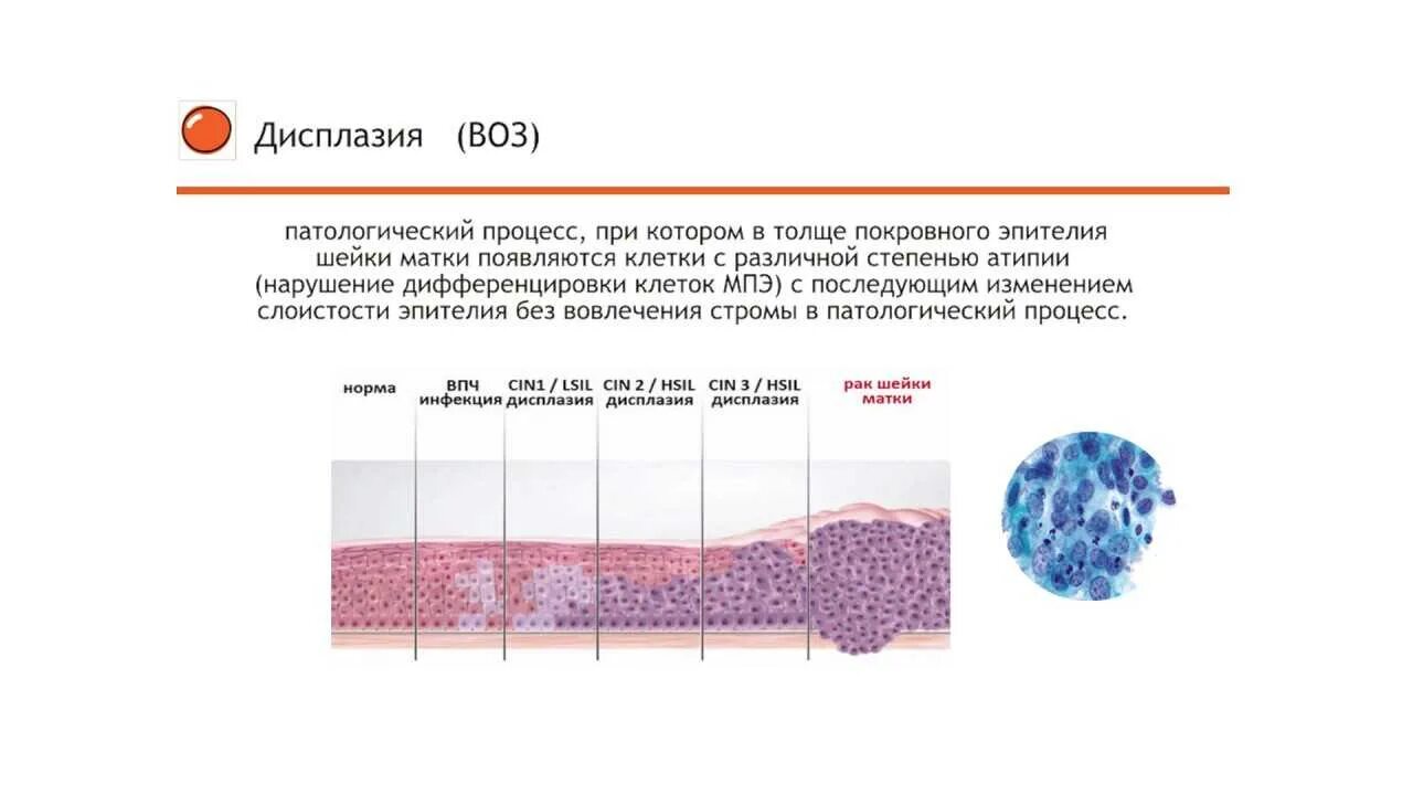 Умеренная дисплазия шейки матки что это. Дисплазия шейки матки Cin 1-2. Гистологическая классификация дисплазий шейки матки. Дисплазия 3 степени шейки матки гистология. Дисплазия шеечного эпителия.