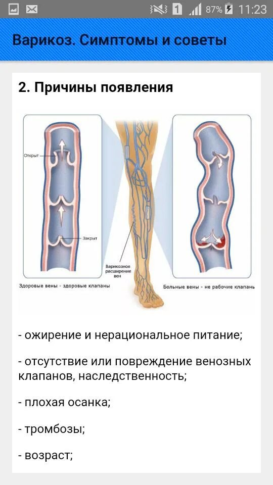 Варикоз причины появления. Варикозное расширение вен причины.