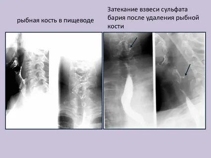 Что делать если косточка от рыбы