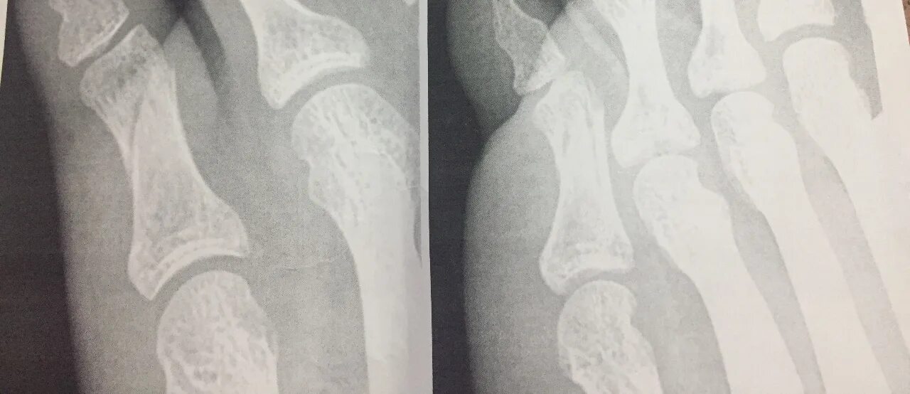 5 фаланга стопы. Перелом фаланги 5 пальца стопы рентген. Краевой перелом фаланги пальца. Вколоченный перелом фаланги 5 пальца стопы. Перелом фаланги рентген.