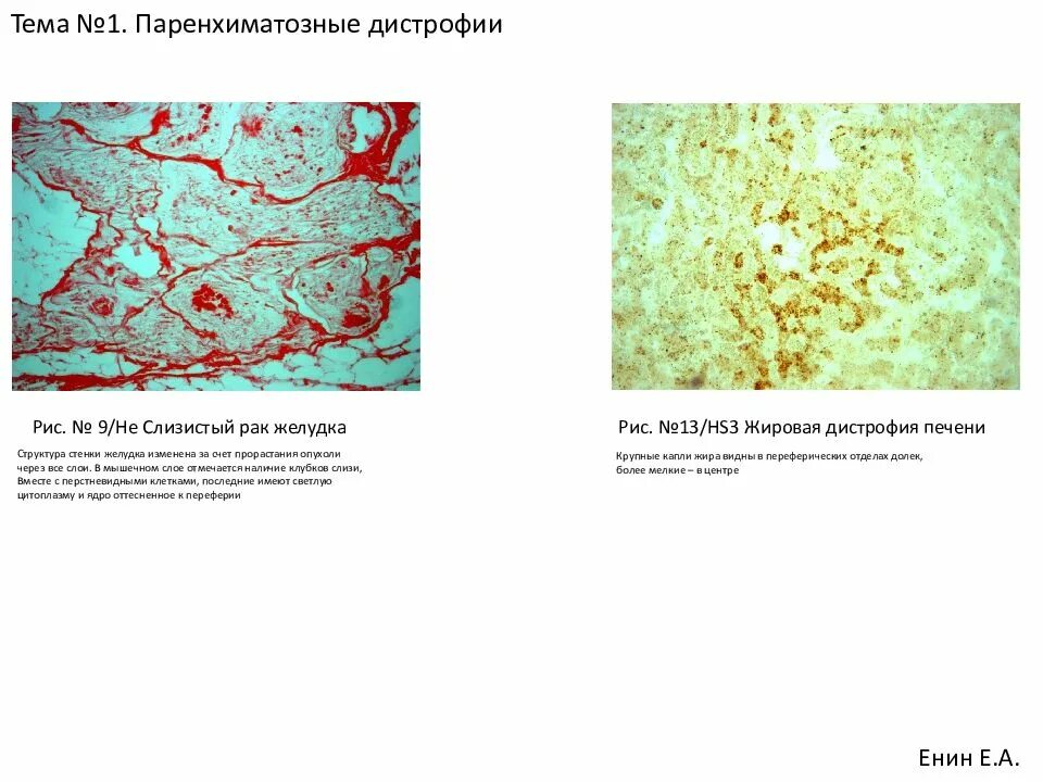 Слизистая паренхиматозная дистрофия. Паренхиматозные углеводные дистрофии. Роговая паренхиматозная дистрофия. Паранзиматозно слизистая дистрофия.