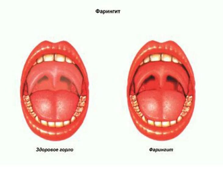 Зев красный. Субатрофический фарингит. Тонзиллиты фарингиты ларингиты.