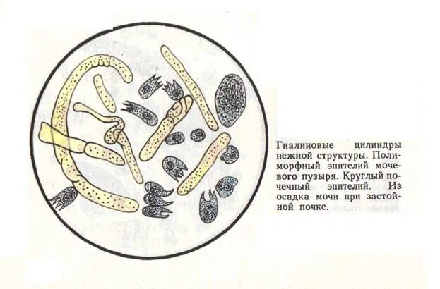 Моча цилиндры гиалиновые повышенные. Гиалиновые цилиндры в моче. Зернистые цилиндры в моче. Гиалиновый цилиндр в моче микроскопия. Гиалиновые цилиндры микроскопия.