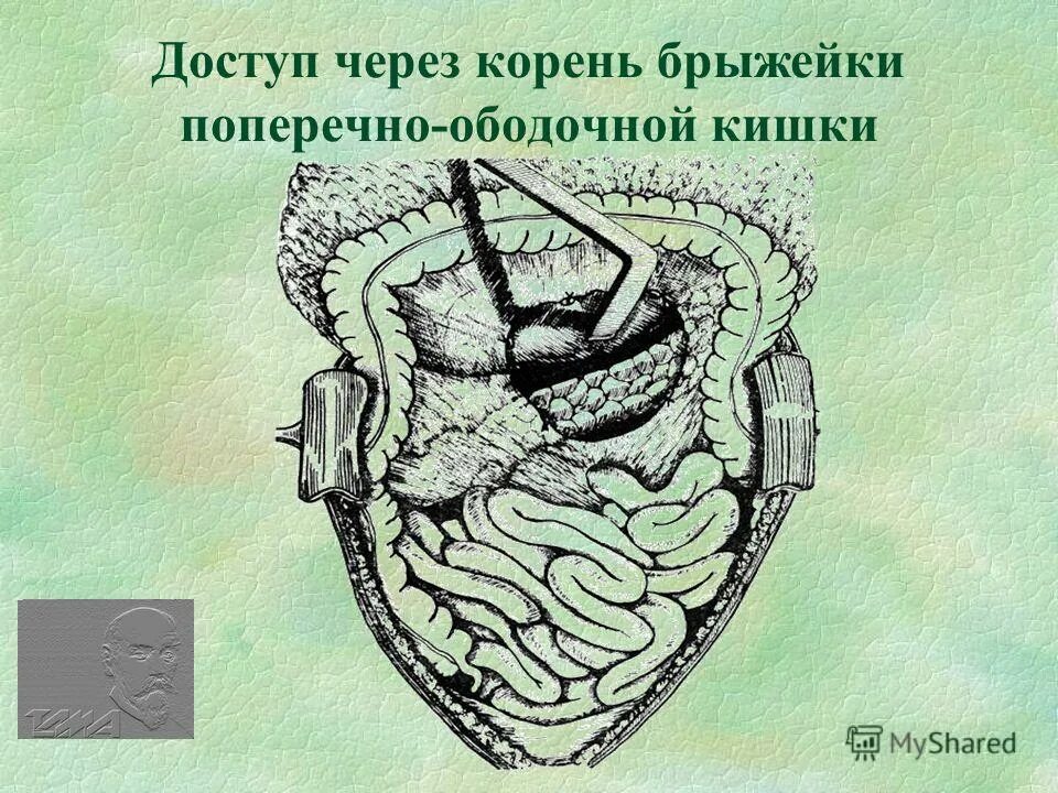 корень брыжейки. корень брыжейки. проекция брыжейки кишечника. строение корня брыжейки.