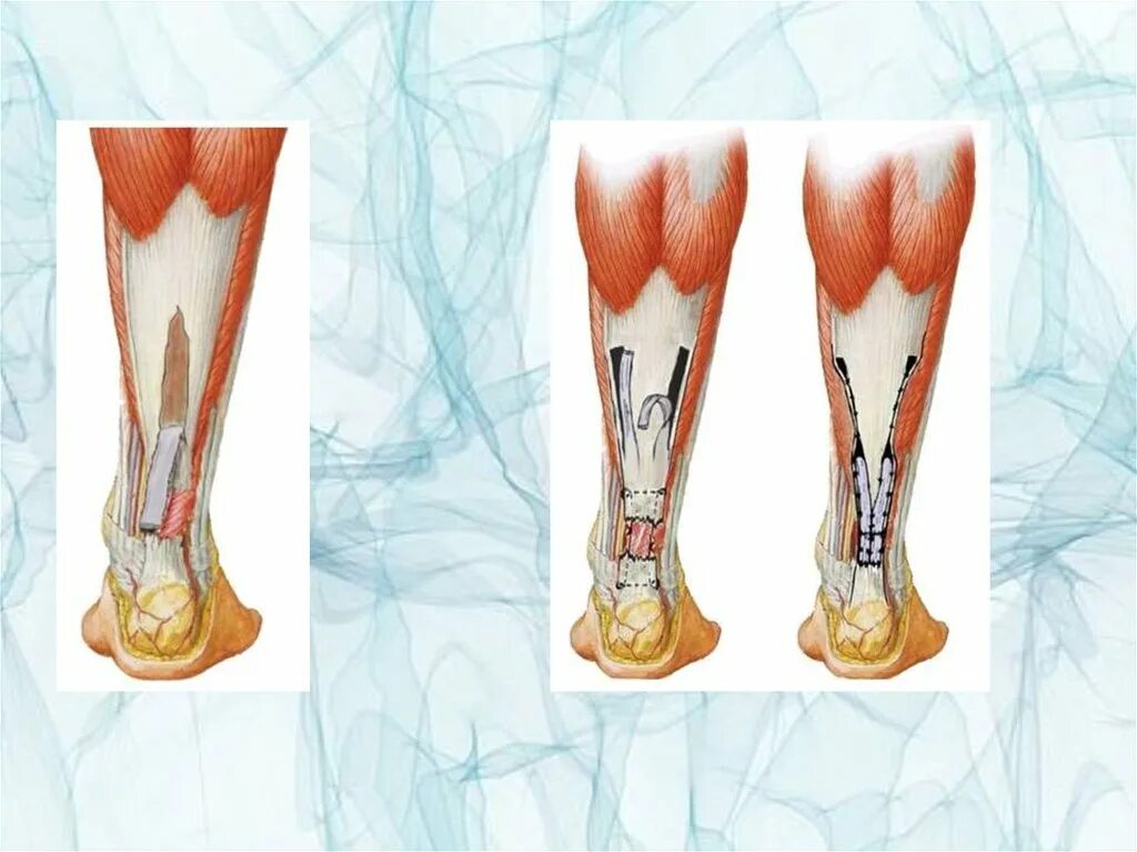 Растяжение ахиллова сухожилия. Аутопластика ахиллова сухожилия. Разрыв ахиллова сухожилия. Подагрический тофус ахиллова сухожилия.