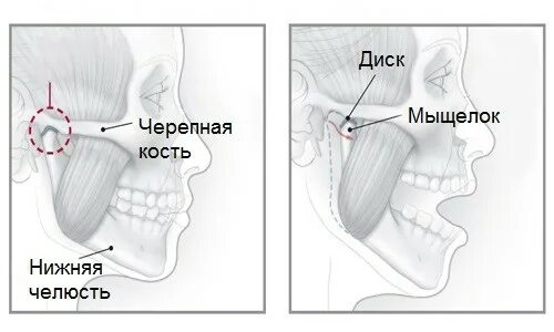 Мыщелки челюсти. Мыщелка нижней челюсти. Смещение челюстного сустава.