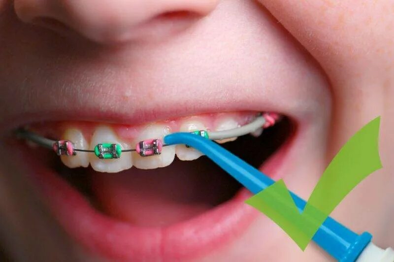 Брекеты для зубов. Зубные брекеты для детей. Скобы для зубов детские. Со скольки лет брекеты можно ставить ребенку