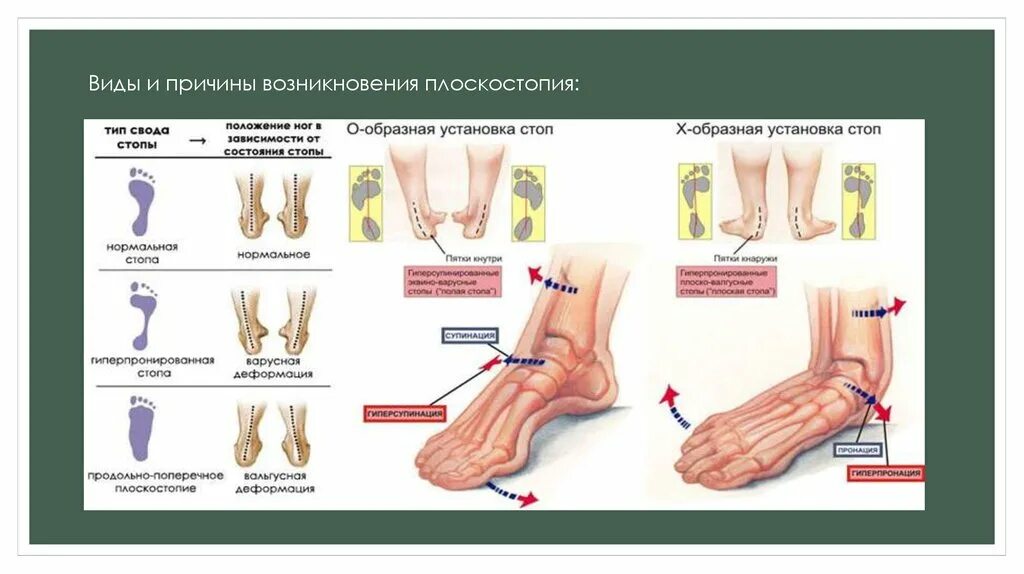 Средняя стопа. Плоскостопие. Причины, последствия, профилактика.. Причины возникновения плоскостопия. Профилактика плоскостопия причины возникновения. Классификация плоскостопия.