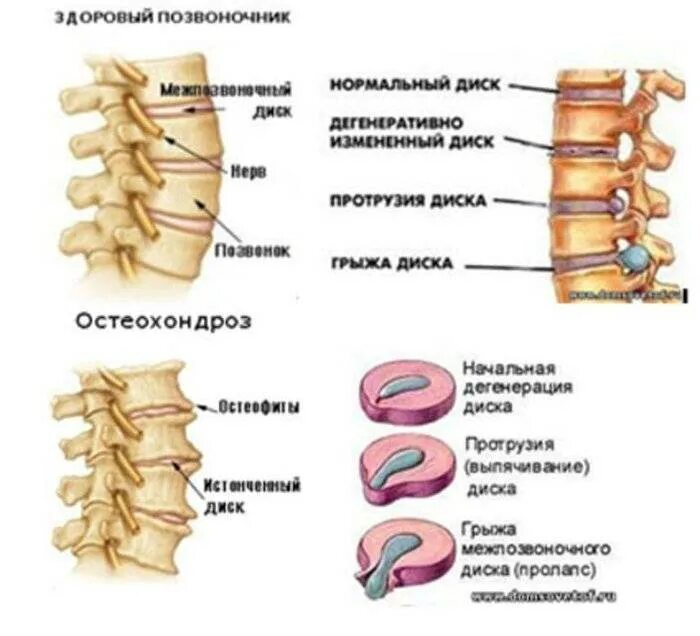 Протрузия дисков лфк