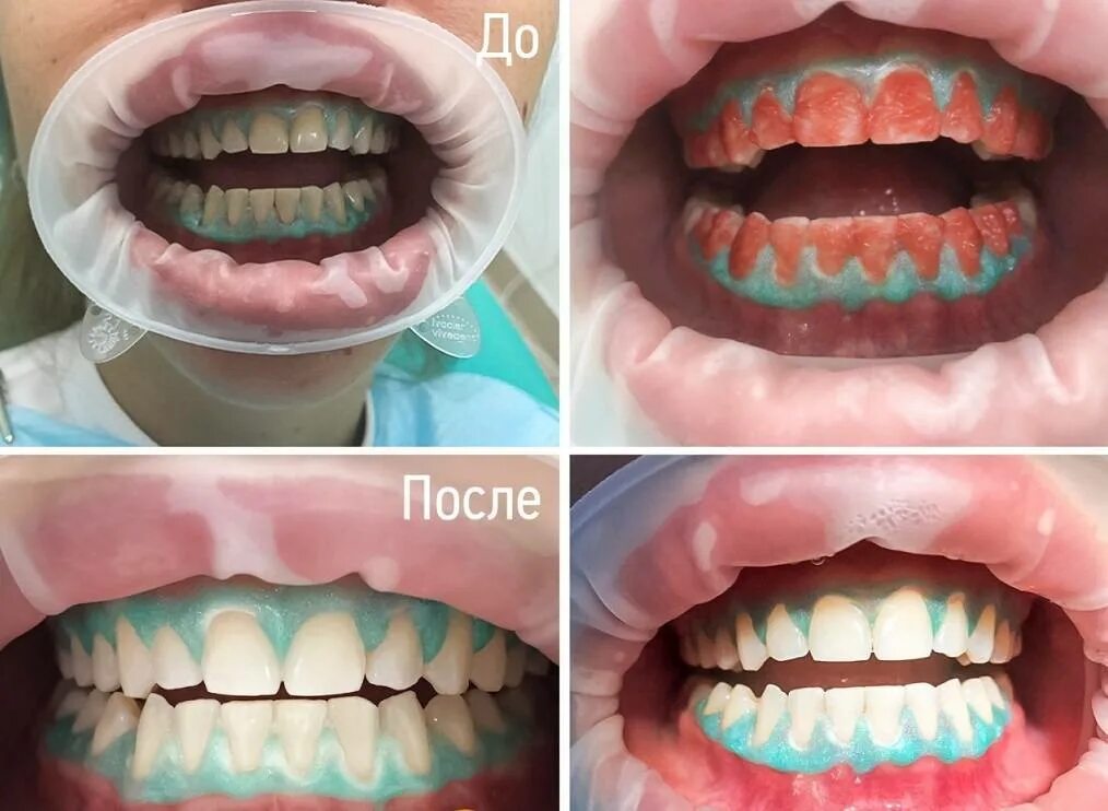 Сколько по времени делают зубы. Лазерное отбеливание Opalescence Boost. Химическое отбеливание Opalescence Boos. Химическое отбеливание Opalescence этапы. Отбеливание Опалесценс буст.