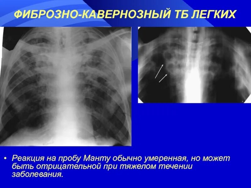 Фиброзно склеротические изменения