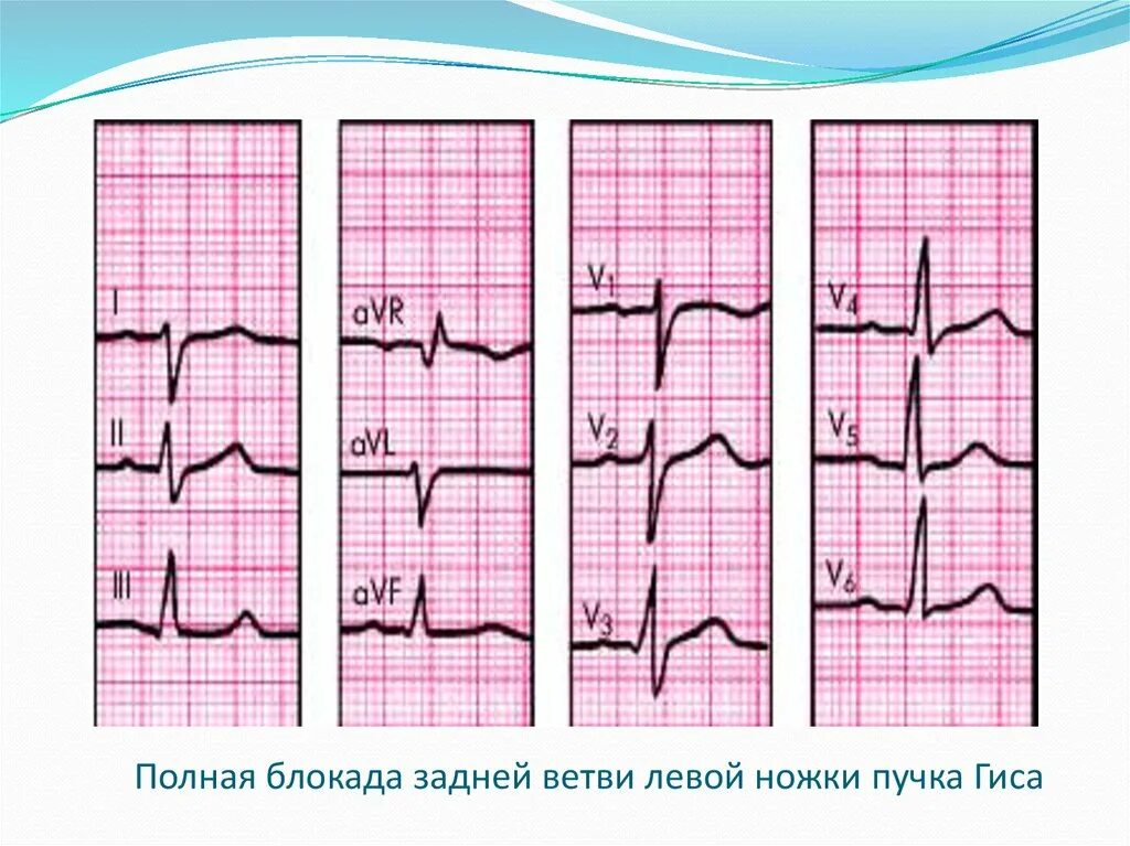 Блокада передней верхней ножки гиса. Блокады ветвей пучка Гиса на ЭКГ. Блокада ПНПГ на ЭКГ. Блокада ЛНПГ на ЭКГ. Блокада левой ножки пучка Гиса на ЭКГ.