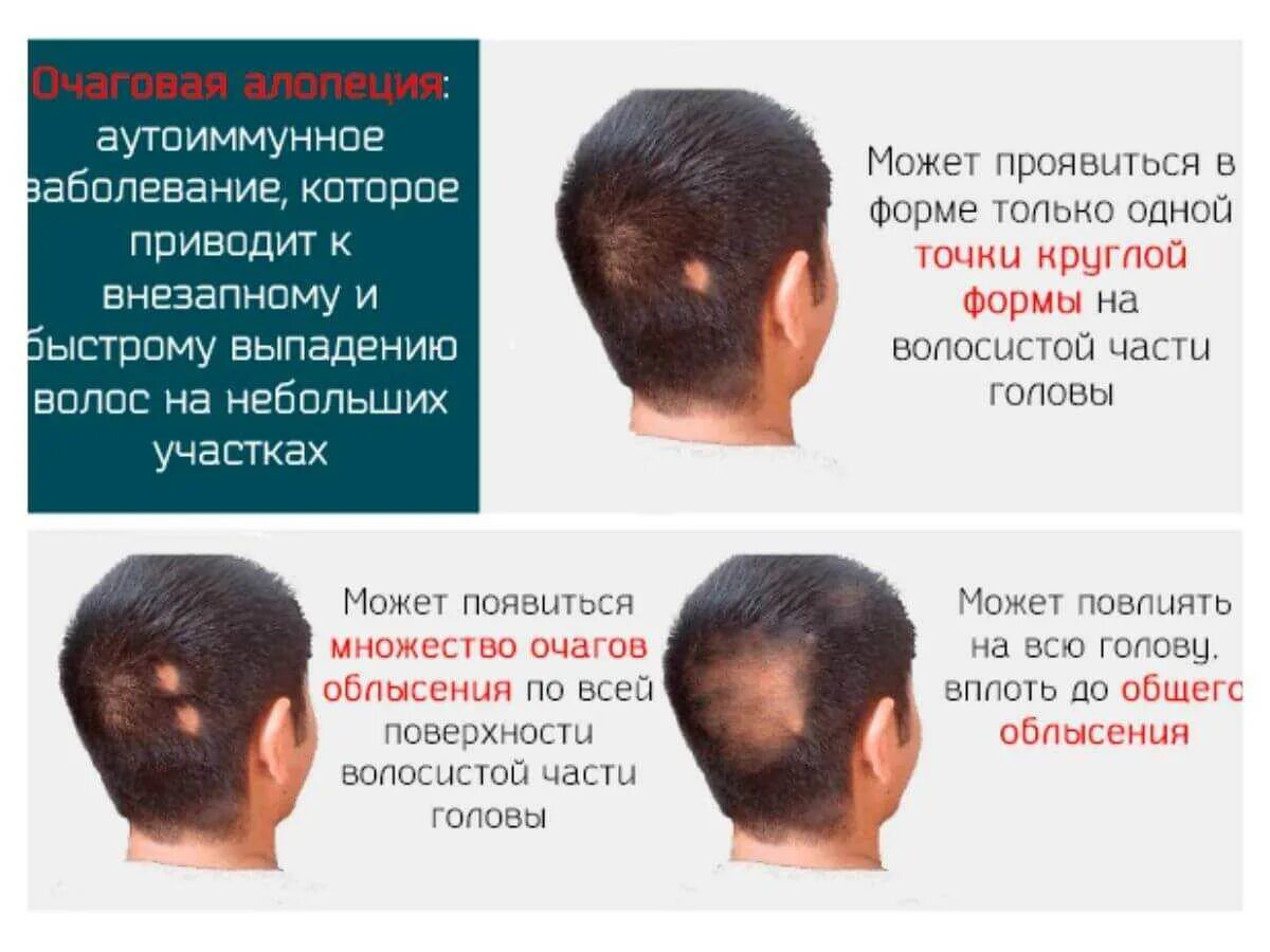 Отчего на голове не растут. Заболевание волос алопеция. залысины на голове у мужчин причины.
