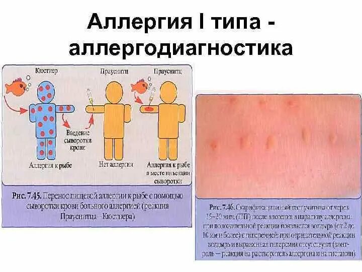 Аллергия на лактозу что нельзя есть - CoffeePapa.ru