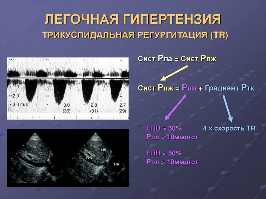 Легочная гипертензия на ЭХОКГ. ЭХОКГ при легочной гипертензии. Легочная гипертензия УЗИ. Степени легочной гипертензии по УЗИ. Легочная гипертензия сдла