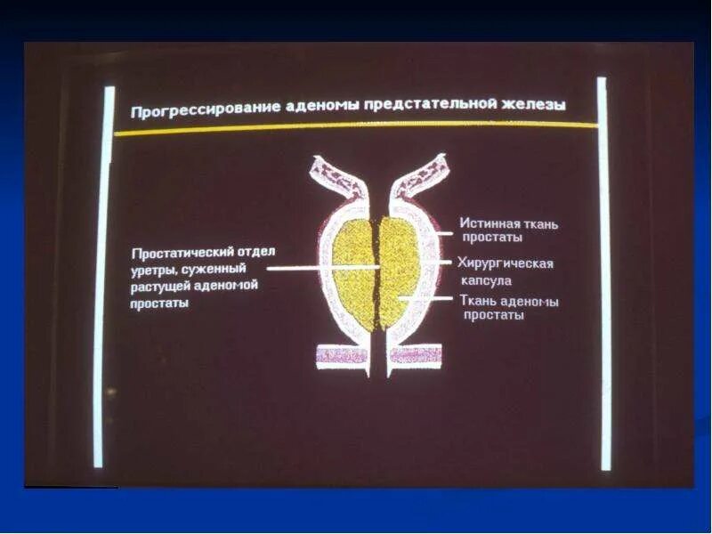 Аденома простаты возраста. Доброкачественная гиперплазия простаты. Капсула предстательной железы. Капсула железы простаты.