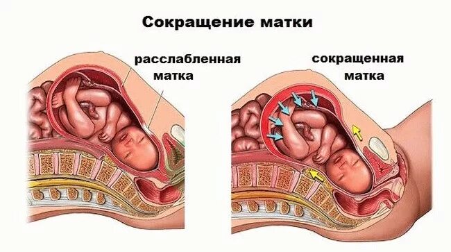 Почему матка приходит в тонус. Снижение тонуса матки.