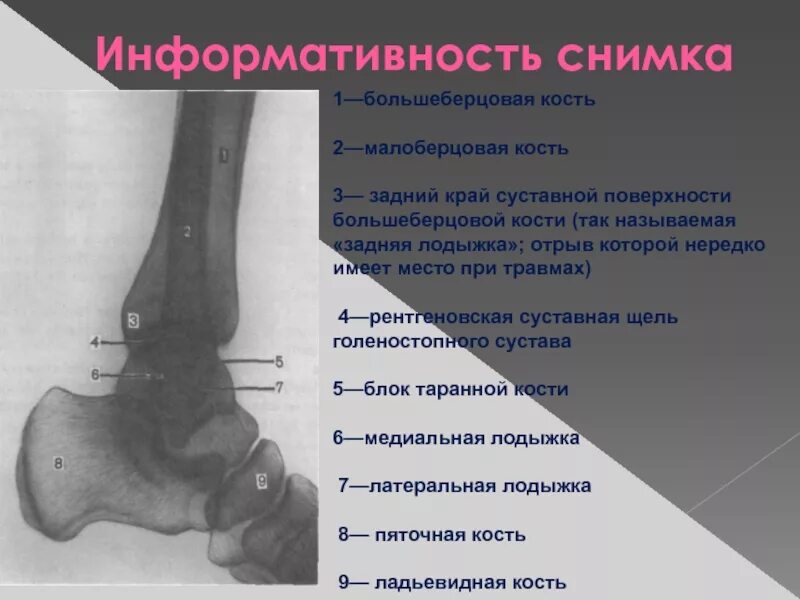 Задний край суставной поверхности большеберцовой кости. Голеностопный сустав рентген анатомия. Перелом заднего края таранной кости. Голеностопный сустав рентген описание. Контузионные изменения кости