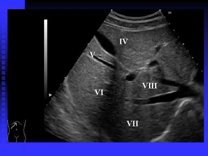 Сегментарное строение печени на УЗИ. Сегменты печени печени на УЗИ. 4 Сегмент печени на УЗИ. Сегменты печени на УЗИ Изранов. Узи печени схема