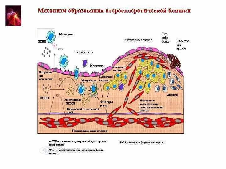 Образование атеросклеротической бляшки. Механизм образования атеросклеротической бляшки. формирование атеросклеротической бляшки патогенез.