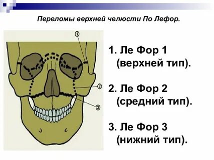 3 перелом