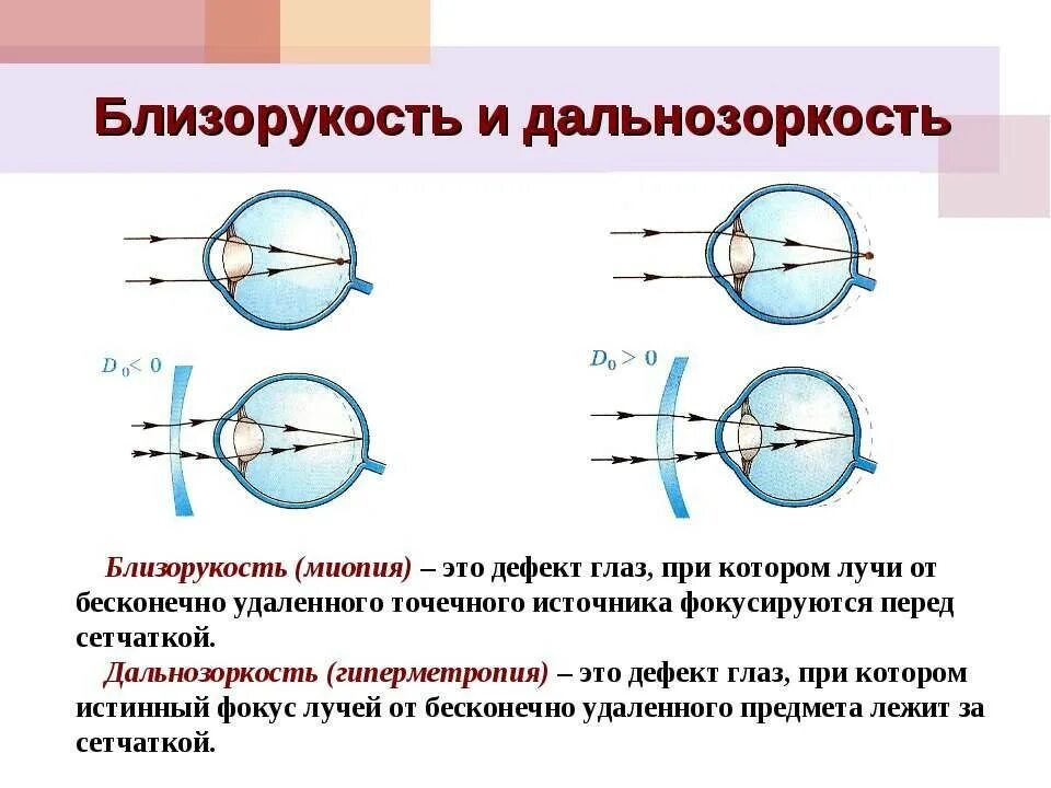 Близорукость первая помощь. Зрение близорукость и дальнозоркость. Линзы для близорукости и дальнозоркости физика. Изменения в глазу при дальнозоркости и близорукости. Близорукость и дальнозоркость схема физика.