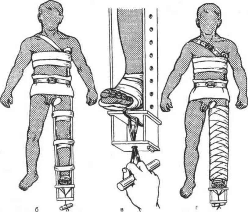 Перелом голени транспортировка. Шина Крамера и Дитерихса. Техника иммобилизации шиной Дитерихса. Транспортная иммобилизация перелома бедра шиной Дитерихса. Наложение шины Дитерихса.