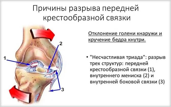 Частичное повреждение волокон передней крестообразной связки колена. Разрыв передней коленной связки колена. Повреждение крестообразных связок 1ст. Разрыв связок ПКС коленного сустава. Взять разрыв