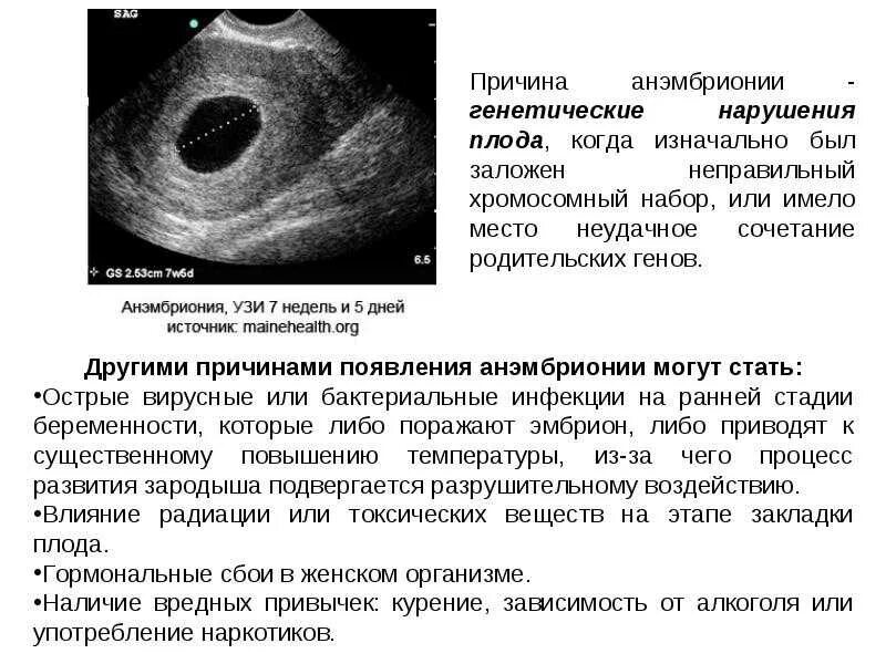 Неразвивающаяся беременность код. Анэмбриония УЗИ признаки. Симптомы замершей беременности на ранних. Неразвивающаяся беременность 7 недель. Анэмбриония – замершая беременность.