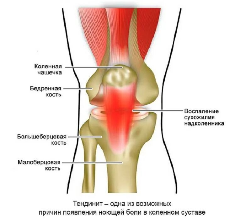 Болит под коленом что это может быть. Тендинит связки надколенника. Тендинит собственной связки надколенника. Воспаление связки надколенника. Тендинит сухожилия подколенной мышцы.