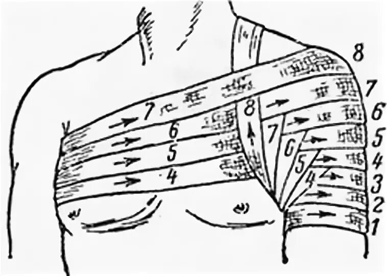Плечевая повязка алгоритм. Перевязка колосовидная на плечо. Наложение колосовидной повязки на плечевой сустав. Техника наложения колосовидной повязки на плечо. Колосовидная повязка на плечевой сустав алгоритм.