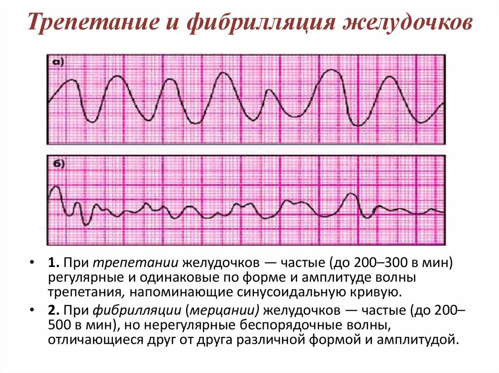 Трепетание и фибрилляция желудочков. ЭКГ при фибрилляции желудочков. Фибрилляция желудочков клинические проявления. Мерцание желудочков на ЭКГ.