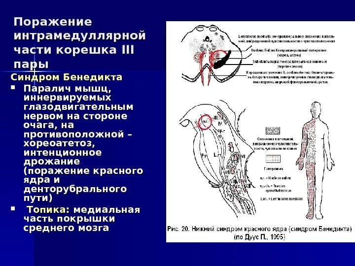 Синдром интрамедуллярного поражения. Альтернирующий паралич Вебера. Поражение 3 нерва