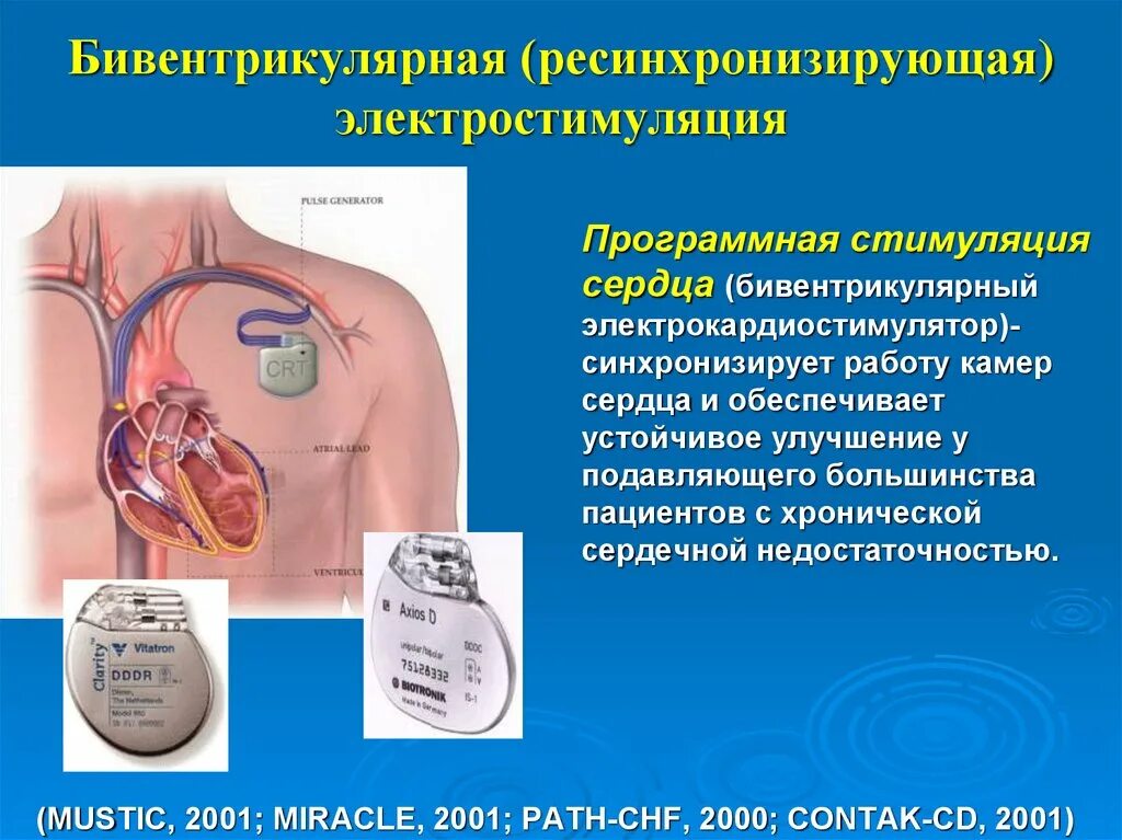 Электростимулятор сердца. Электрокардиостимулятора сердца. Трехкамерный кардиостимулятор.