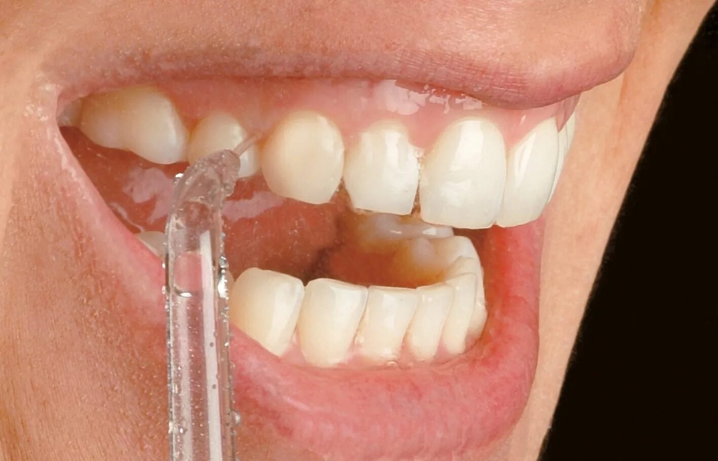 Ирригатор для зубов. Ирригация полости рта. Ирригатор в стоматологии. Как чистить десна