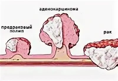 Какие виды полипа