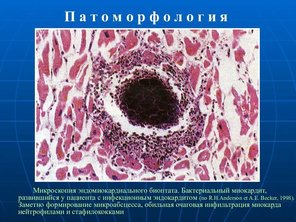 Инфильтрация нейтрофилами. Инфекционный эндокардит патанатомия. Инфекционный эндокардит морфология. Инфекционный эндокардит микропрепараты. Затяжной септический эндокардит патанатомия.