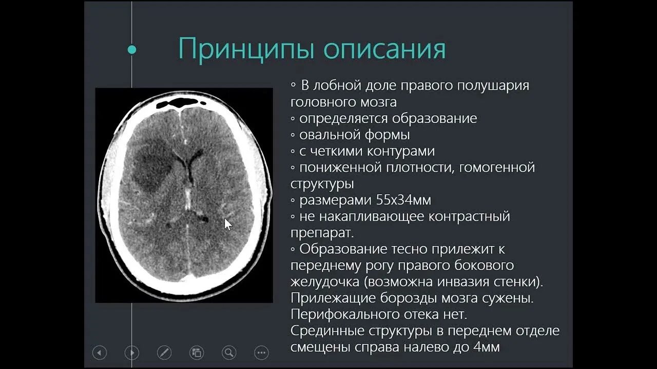 Слово на кт начинается. Кт грудной клетки проекции. Слово на кт начинается. Фронтальная реконструкция кт. Кт.