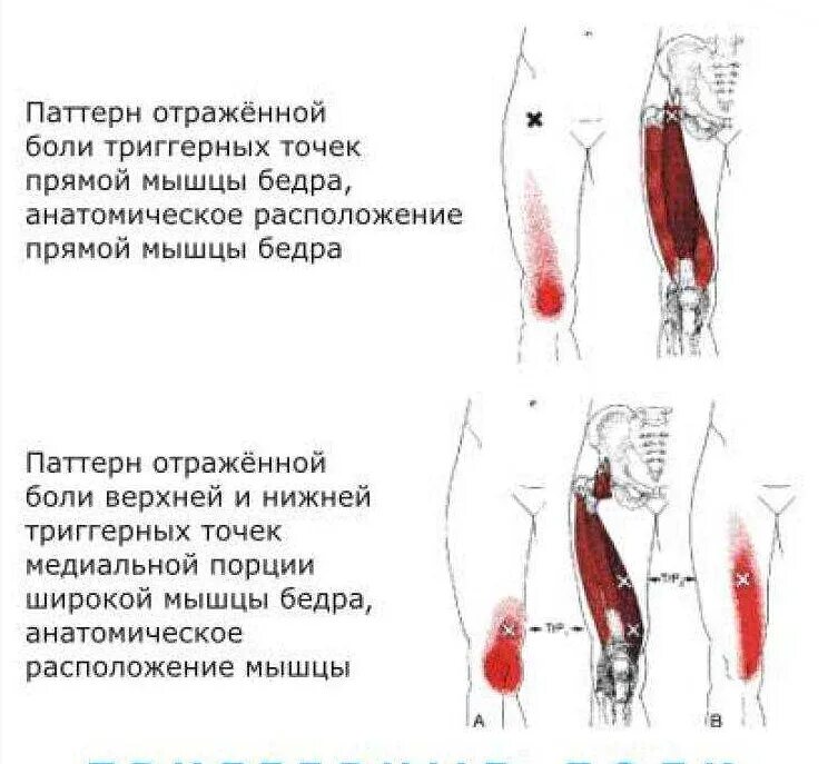 Боль от бедра до стопы. Болит мышца бедра сбоку. Триггерные точки колена. Триггерные точки прямой мышцы бедра. Триггерные точки четырехглавой мышцы бедра.