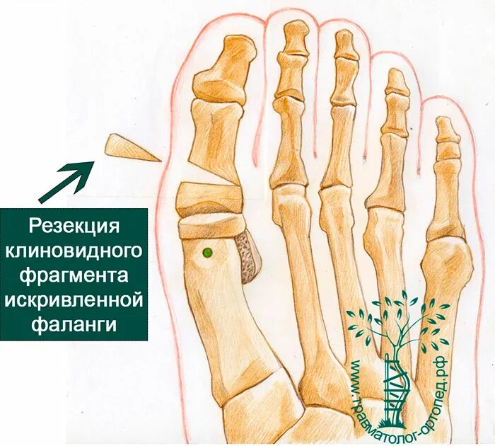 Основные фаланги стопы. Клиновидная остеотомия 1 плюсневой кости стопы. Клиновидная резекция кости. Остеотомия костей стопы. Кости фаланг пальцев стопы.