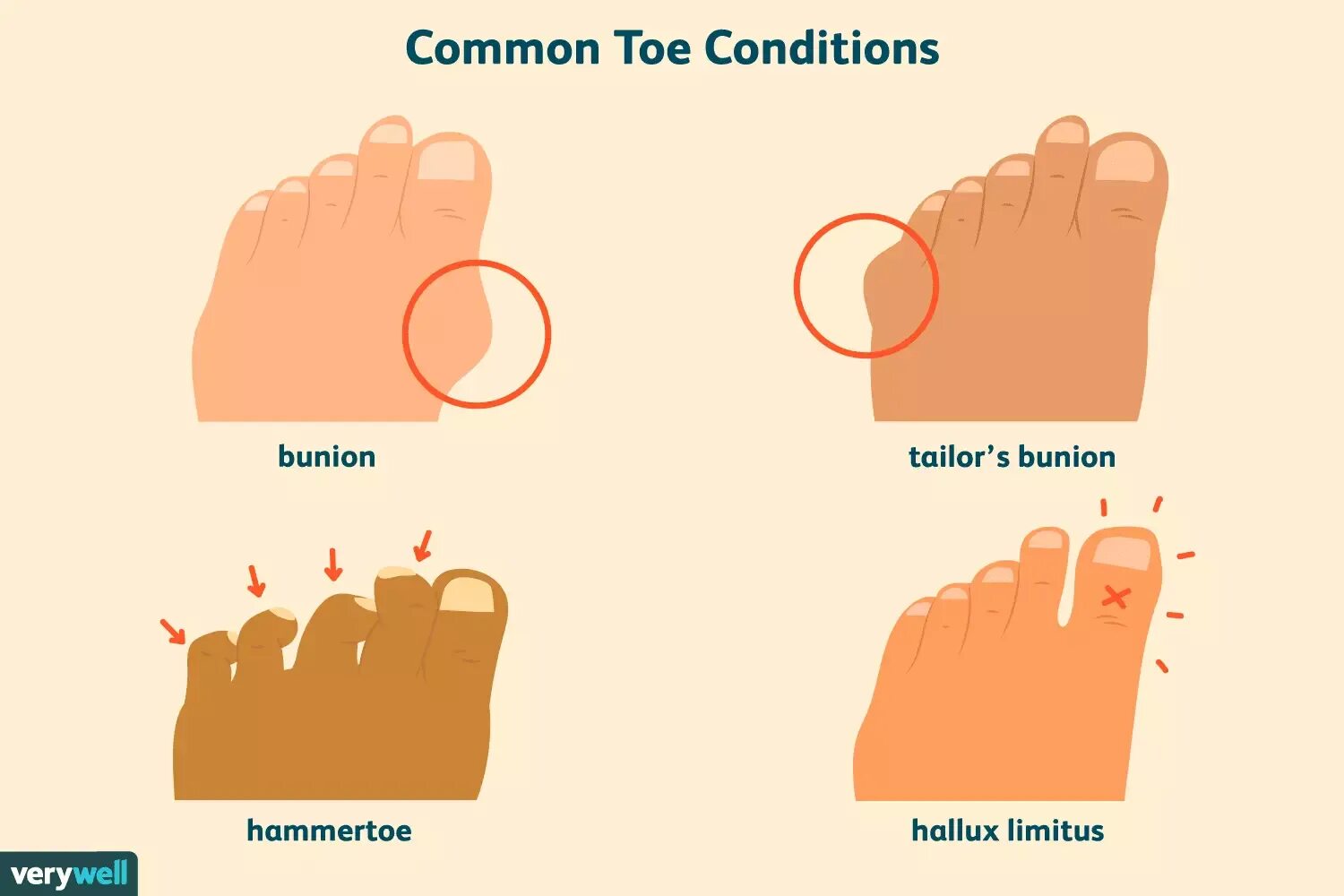 Toes произношение. Tailor's Bunion. Тактика Toe to Toe.