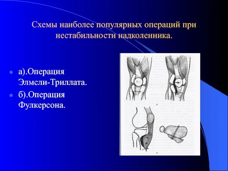 Латерализация надколенника. Операции при привычном вывихе надколенника. Операция при нестабильности надколенника. Операция при вывихе надколенника.