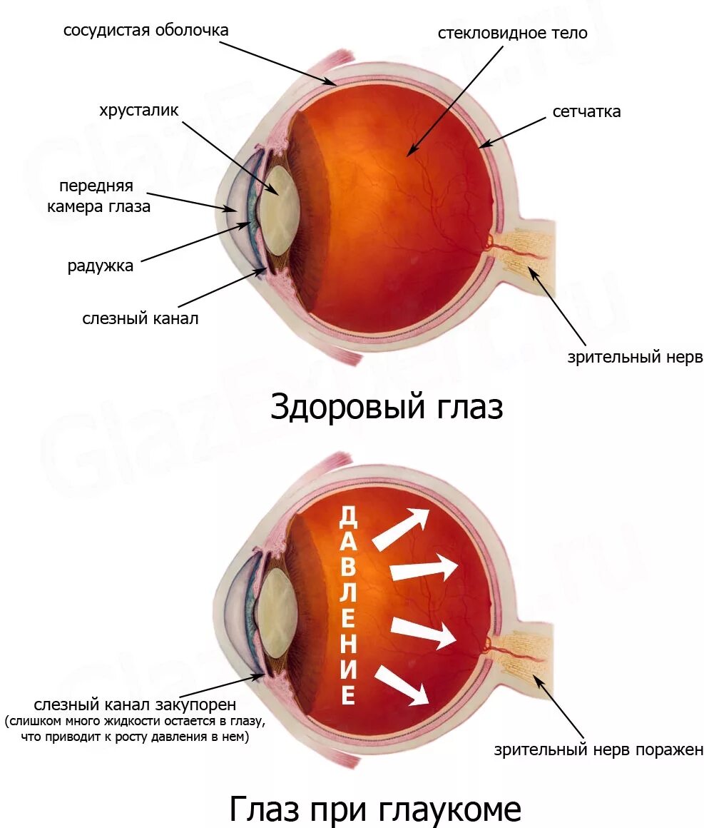 Глаукома схема глаза. Глаукома строение глаза. Здоровый глаз и глаз при глаукоме. Причины глаукомы глаза