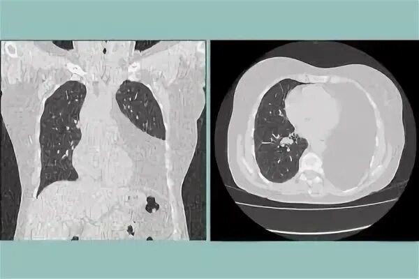 липоматоза переднего