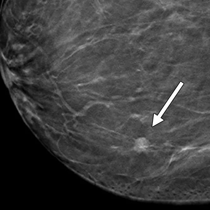 Маммография старый. Bi rads 4 кальцинаты. Bi rads 4 б маммография. Левая молочная железа birads 4а. Bi rads 5 на маммографии.