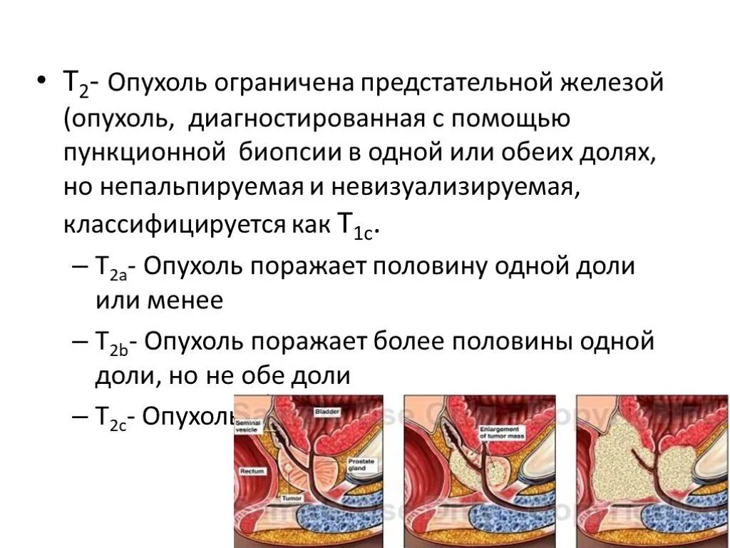 Стадии предстательной железы прогноз. Опухоли предстательной железы классификация. Опухоль предстательной железы т2. Объемное образование предстательной железы. Стадии ЗНО предстательной железы.